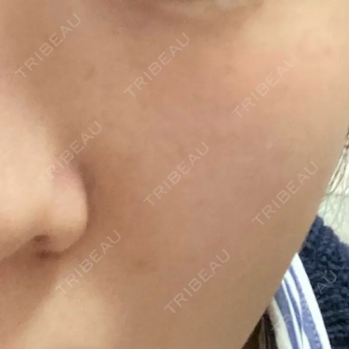 光治療（フォトフェイシャルなど） MKクリニック 日本橋院 BEFORE メイン用