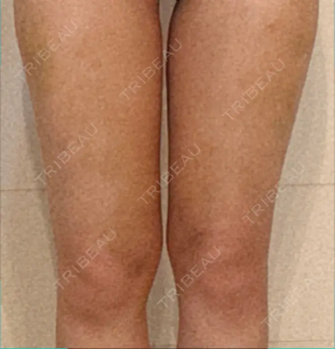 インディバ（脚） WOM SALON【術後ケア取扱いサロン】 BEFORE メイン用