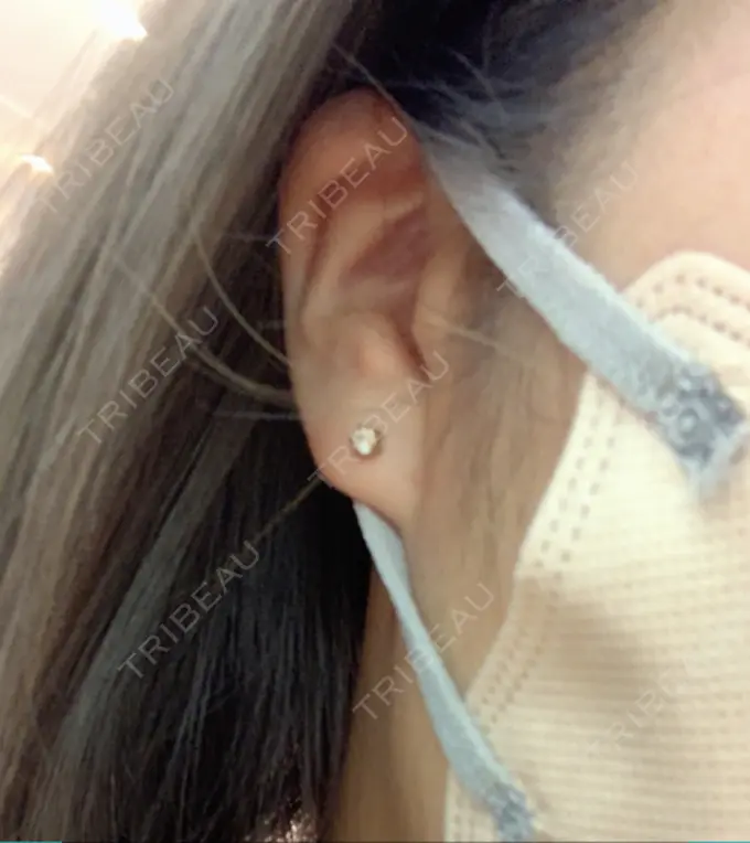 ピアス穴あけ アイ&スキンクリニック東京ソラマチ BEFORE メイン用