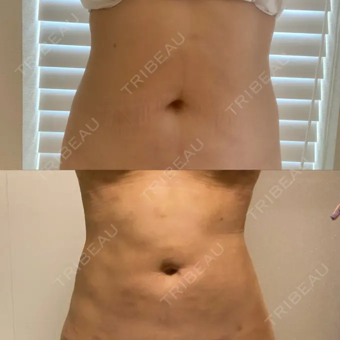 脂肪吸引（お腹） / 脂肪吸引（腰） / 脂肪吸引（背中） WOM CLINIC GINZA （ワム クリニック ギンザ） BEFORE メイン用