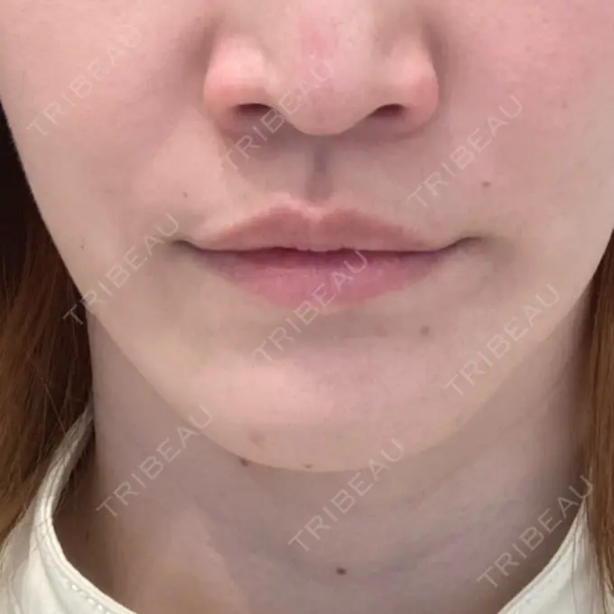 アートメイク（唇） エースクリニック 大阪梅田HEPナビオ院 BEFORE メイン用