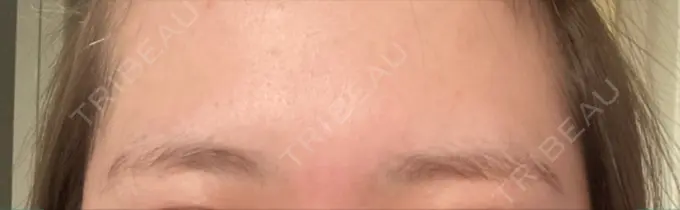 アートメイク（眉） 表参道メディカルクリニック 福岡天神院 BEFORE メイン用