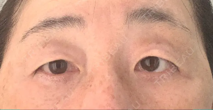 眉下切開 みずほクリニック BEFORE メイン用