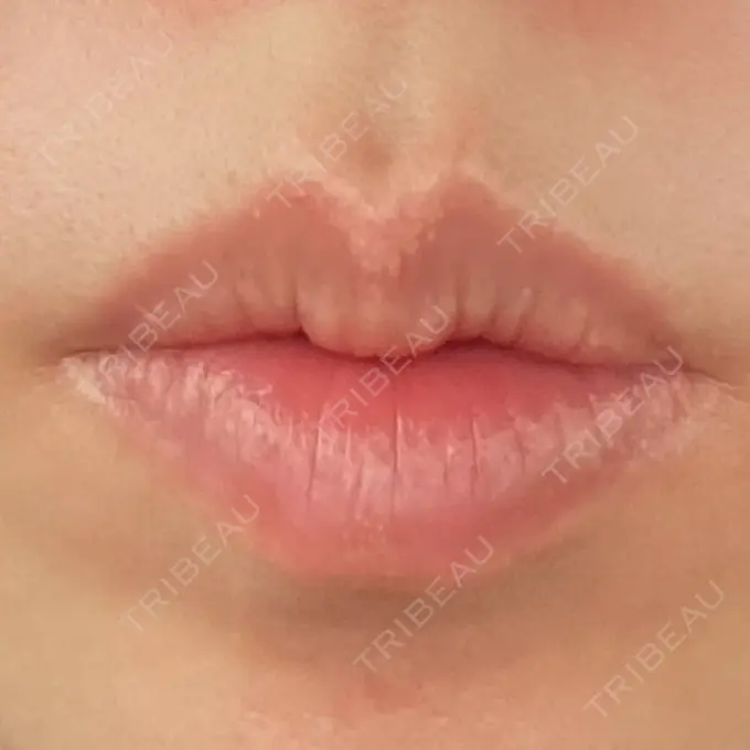 ヒアルロン酸注入（唇） / ボトックス（口角） アリエル美容クリニック 郡山院 BEFORE メイン用