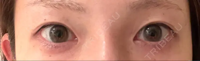 二重切開 有楽町高野美容クリニック BEFORE メイン用