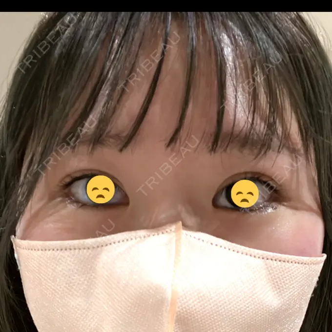 ヒアルロン酸注入（涙袋） 吉祥寺アイビークリニック BEFORE メイン用