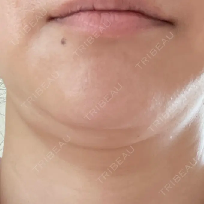 糸リフト / 脂肪吸引（顔） 湘南美容クリニック 岡山院 BEFORE メイン用