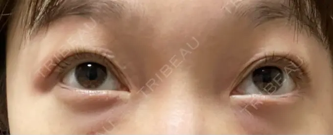 クマ治療 / 下まぶたたるみ取り / 脂肪注入（目の下） セオリークリニック BEFORE メイン用