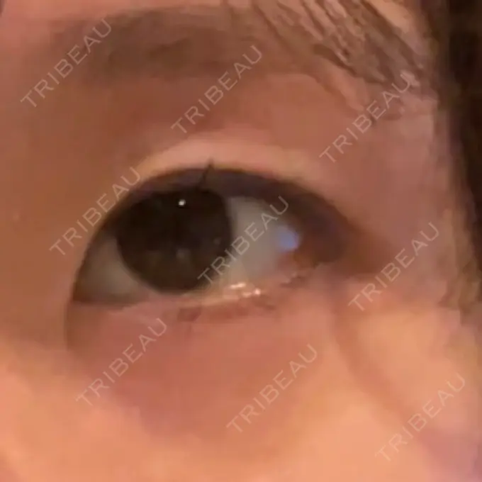 二重埋没 yuzawa clinic BEFORE メイン用