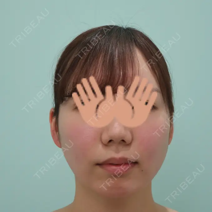 あごプロテーゼ WOM CLINIC GINZA （ワム クリニック ギンザ） BEFORE メイン用