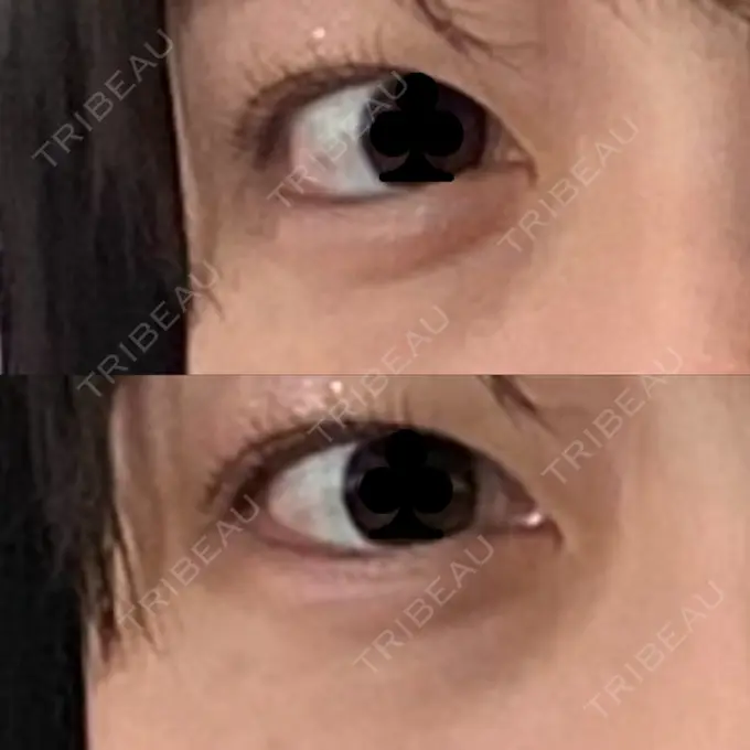 下まぶたたるみ取り / 下まぶたの脂肪取り / その他（目元） 吉井クリニック BEFORE メイン用