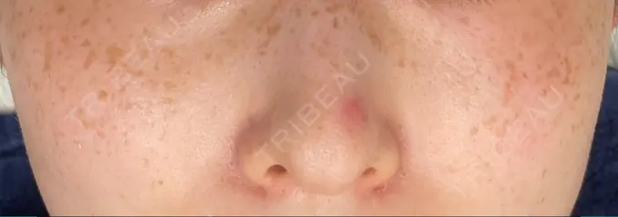 ピコスポット LOUIS CLINIC 二子玉川院【ルイクリニック】 BEFORE メイン用