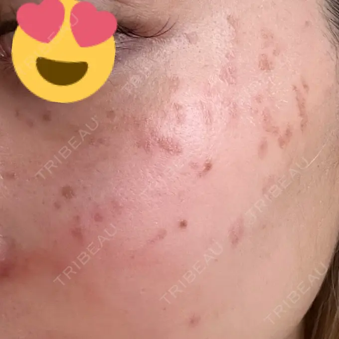 ヒアルロン酸注入（頬） / ヒアルロン酸注入（こめかみ） / ピコスポット LOUIS CLINIC 二子玉川院【ルイクリニック】 BEFORE メイン用