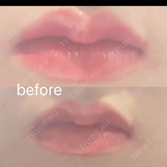 その他（口元） Mavie Beauty Clinic （マヴィービューティークリニック） BEFORE メイン用