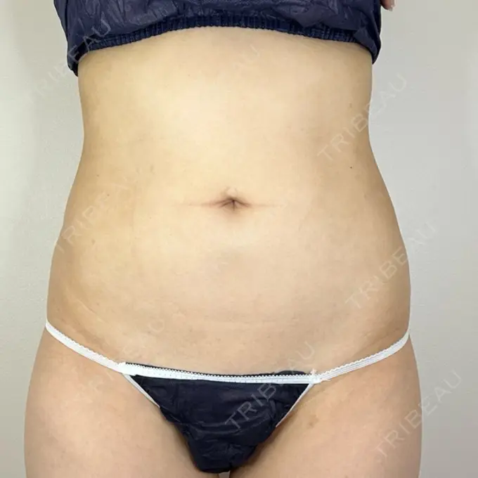 脂肪吸引（お腹） / 脂肪吸引（腰） GAYA body design clinic BEFORE メイン用