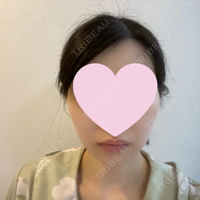 糸リフト / クマ治療 / 下まぶたの脂肪取り / ボトックス（額） Mods Clinic（モッズクリニック） 名古屋院 BEFORE メイン用