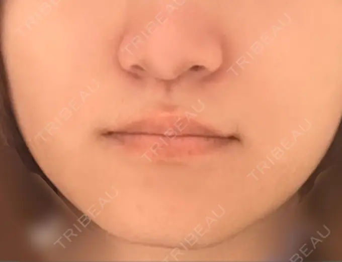 ボトックス（エラ・小顔） / ハイフ（顔） TCB東京中央美容外科 六本木院 BEFORE メイン用