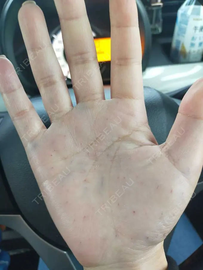 多汗症治療（ボトックス） ルラ美容クリニック 神戸院 BEFORE メイン用