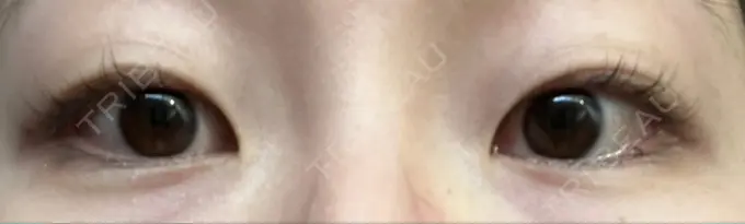 二重埋没 グローバルビューティークリニック 東京院 BEFORE メイン用