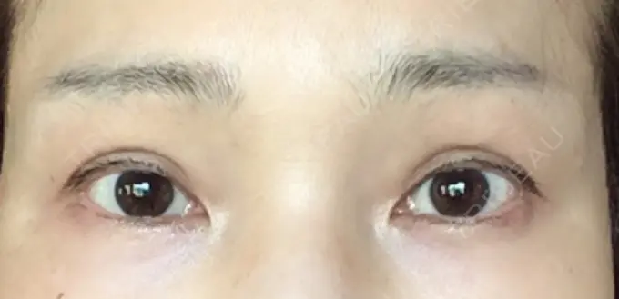 二重埋没 / 目元修正 オーキッド美容クリニック東京御徒町 BEFORE メイン用