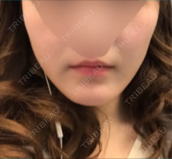 骨切り（あご） / 骨削り（エラ） / 骨削り（頬） id（アイディ）美容外科 BEFORE メイン用