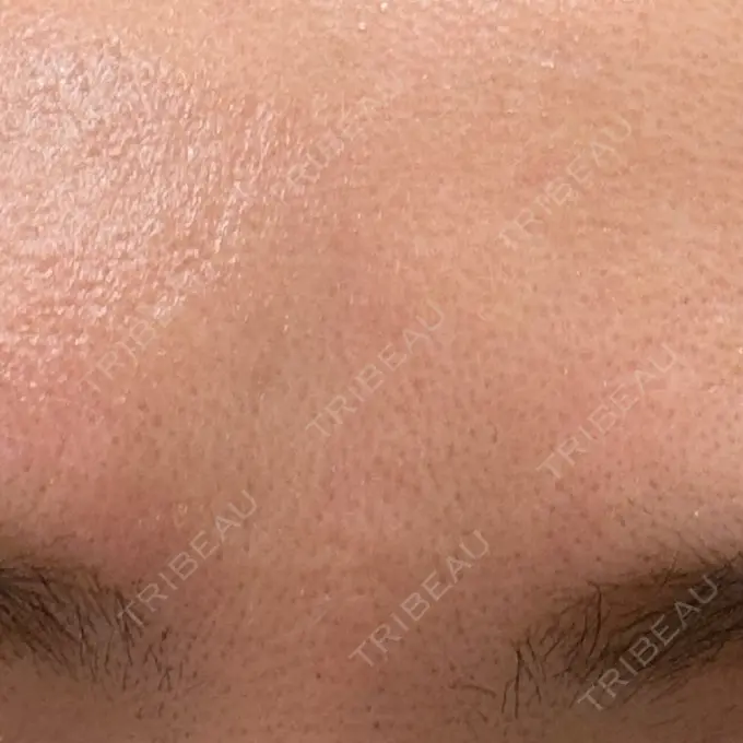 美容点滴・美容注射（美肌） 品川スキンクリニック広島院 BEFORE メイン用