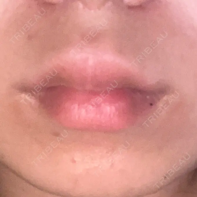 ボトックス（口角） みずほクリニック BEFORE メイン用