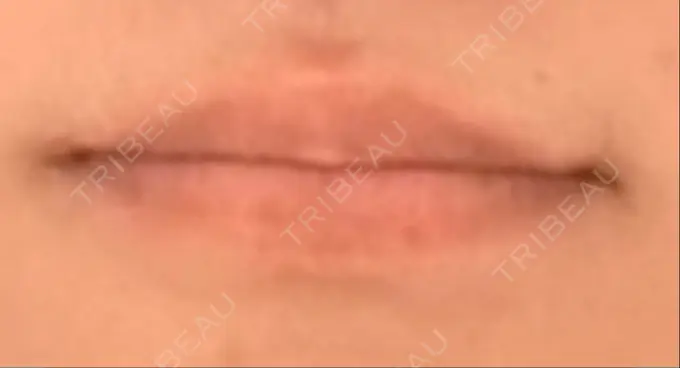 ボトックス（口角） Mavie Beauty Clinic （マヴィービューティークリニック） BEFORE メイン用