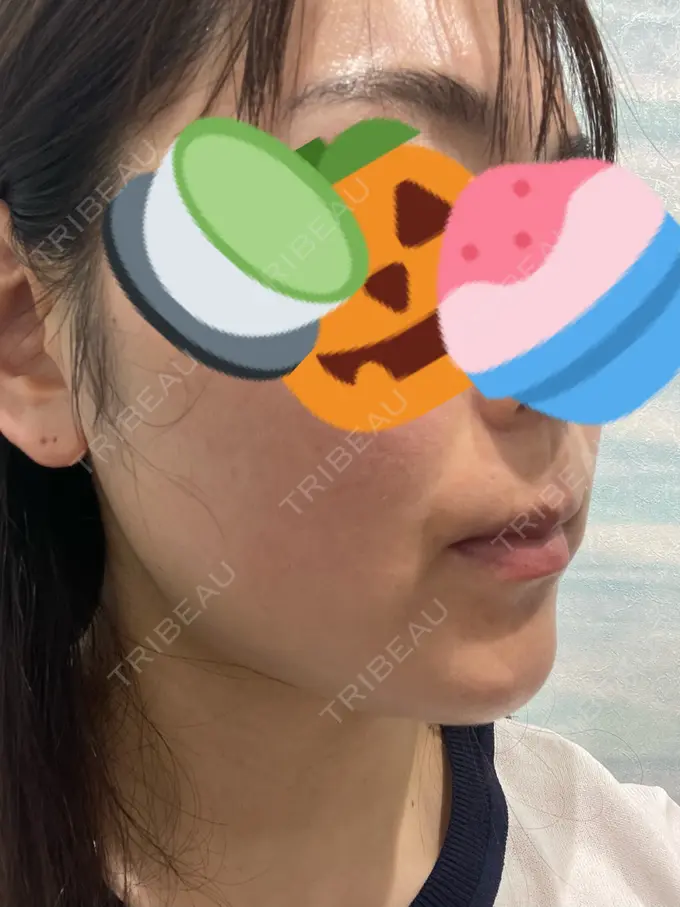 ピコレーザートーニング（美白・肝斑） アモーレクリニック 名古屋院 BEFORE メイン用