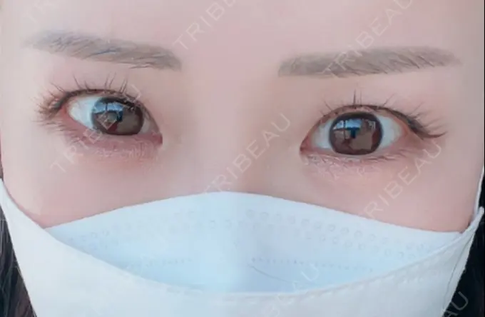 ボトックス（タレ目） ルラ美容クリニック 渋谷本院 BEFORE メイン用