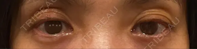 その他（目元） みずほクリニック BEFORE メイン用