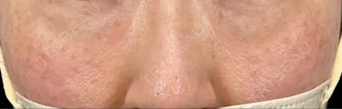 イオン導入 / 光治療（フォトフェイシャルなど） メディアージュクリニック 青山院 BEFORE メイン用