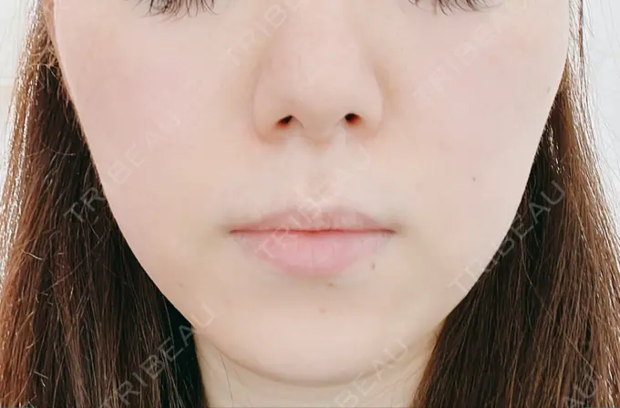 エレクトロポレーション 若倉診療所 BEFORE メイン用