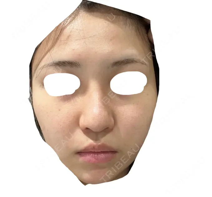 エレクトロポレーション / 毛穴洗浄（ハイドラフェイシャルなど） / 光治療（フォトフェイシャルなど） X CLINIC 大阪院 BEFORE メイン用