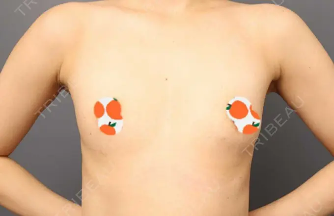 豊胸（脂肪注入） THE CLINIC（ザ・クリニック） 東京院 BEFORE メイン用