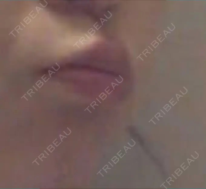 アートメイク（唇） LEAGRANT CLINIC 中目黒 BEFORE メイン用