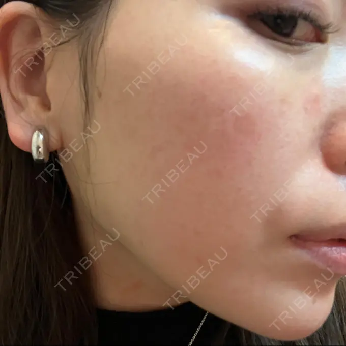 ピコスポット UB CLINIC立川 BEFORE メイン用