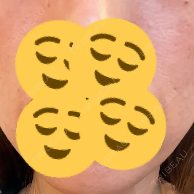 ピコレーザートーニング（美白・肝斑） / ピコフラクショナルレーザー（毛穴・ニキビ跡） ルラ美容クリニック 高田馬場院 BEFORE メイン用