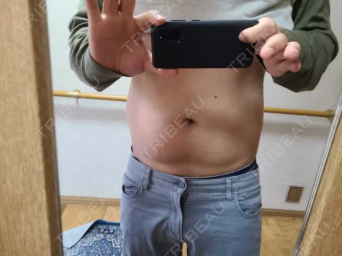 脂肪冷却（お腹） みずほクリニック BEFORE メイン用