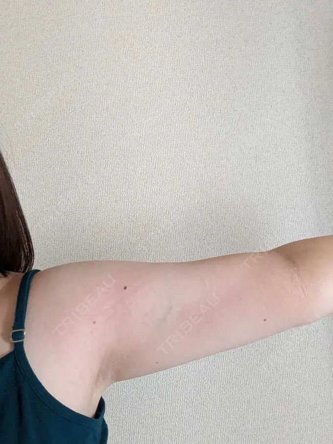 脂肪吸引（二の腕） 石倉クリニック 水戸院 BEFORE メイン用