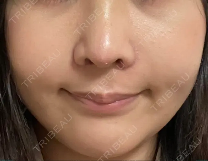 LED治療 id美容クリニック 銀座院 BEFORE メイン用