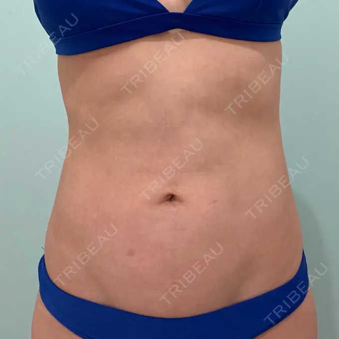 脂肪吸引（お腹） / 脂肪吸引（腰） WOM CLINIC GINZA （ワム クリニック ギンザ） BEFORE メイン用