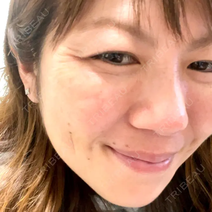 ボトックス（目尻） TCB東京中央美容外科 立川院 BEFORE メイン用