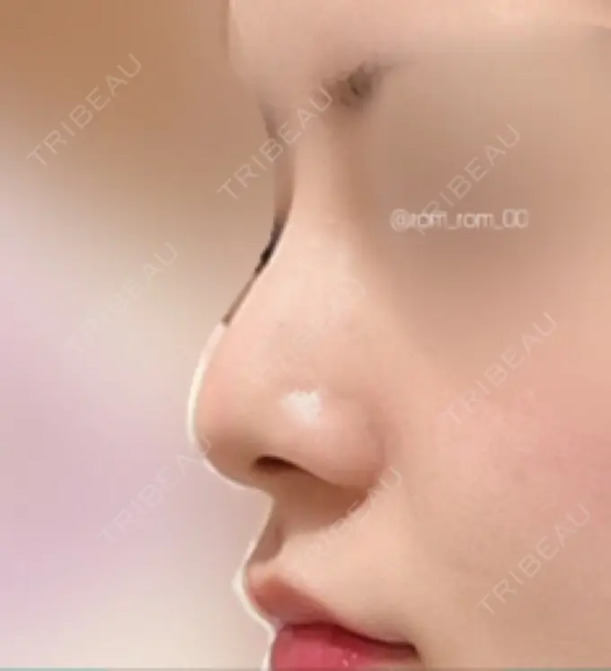 鼻尖形成（切開） / 鼻中隔延長（切開） / 軟骨移植 / 眉間プロテーゼ / 鼻修正 ミナ美容外科 BEFORE メイン用