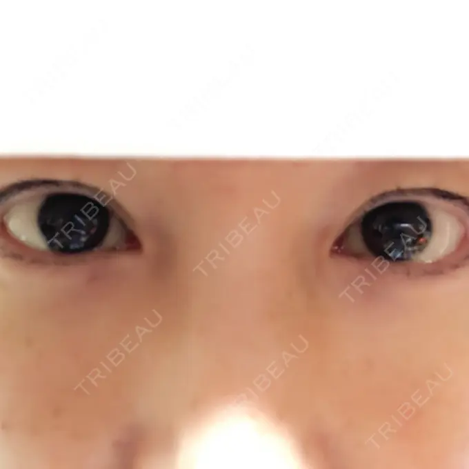 二重埋没 湘南美容クリニック 東京蒲田院 BEFORE メイン用