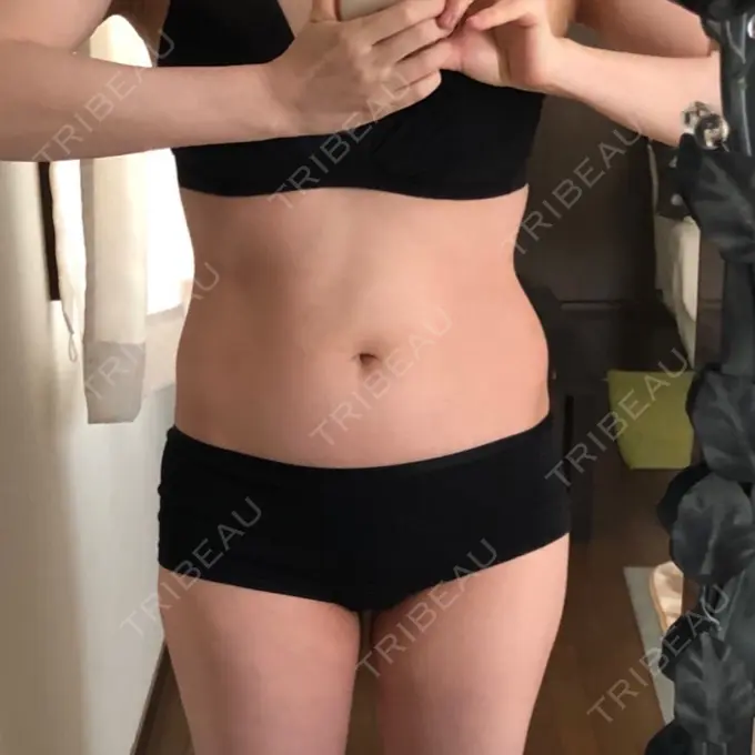 脂肪吸引（お腹） 城本クリニック 富山院 BEFORE メイン用