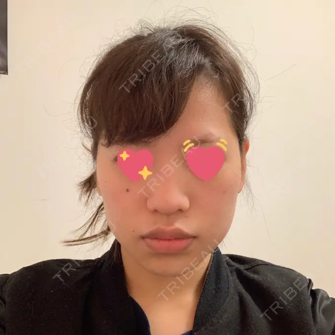 隆鼻術 / 鼻尖形成（切開） / 小鼻縮小（切開） / 軟骨移植 湘南美容クリニック 新橋銀座口院 BEFORE メイン用