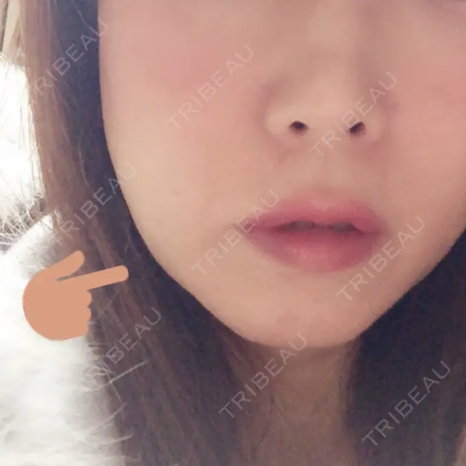 脂肪溶解注射（顔） 湘南美容クリニック 東京蒲田院 BEFORE メイン用