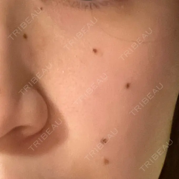 ほくろ・いぼ除去レーザー（肌） Fellez Clinic【フェルズクリニック】 BEFORE メイン用