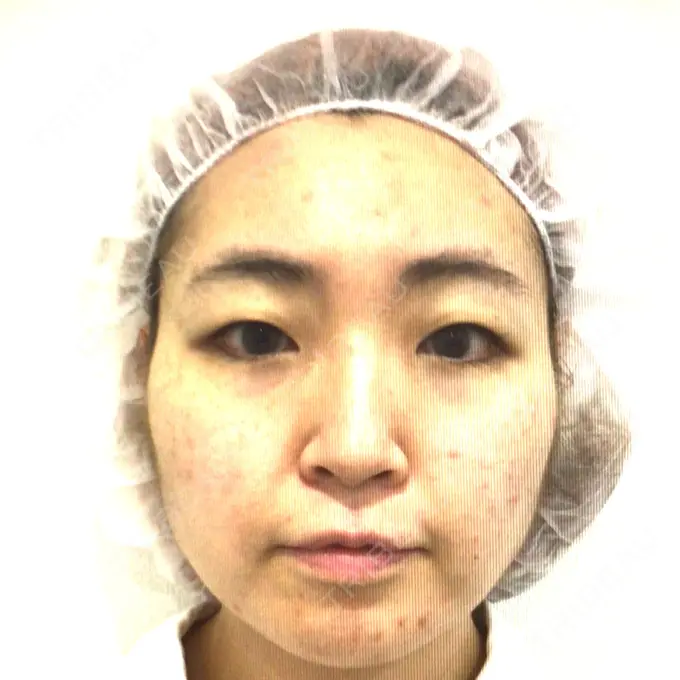 二重埋没 HAAB BEAUTY CLINIC 横浜院 BEFORE メイン用